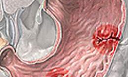 D&#249;ng corticosteroid trong điều trị bệnh khớp